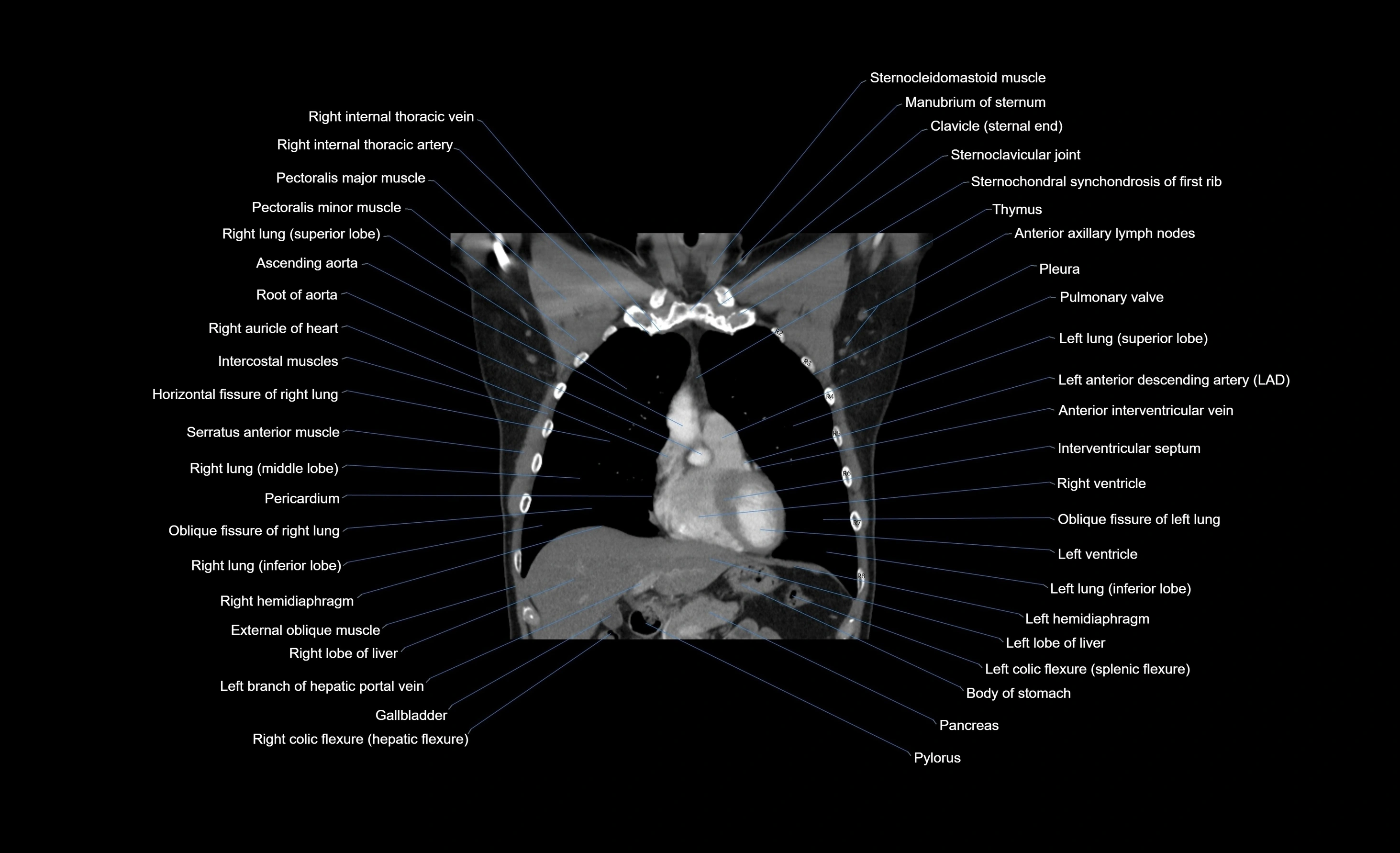 CT chest (thorax) labelled coronal cross sectional anatomy radiology image-00081.webp